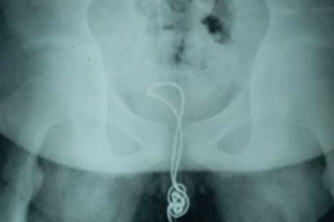 Adolescente "curioso" se introdujo un cable USB que acabó enredado en su vejiga