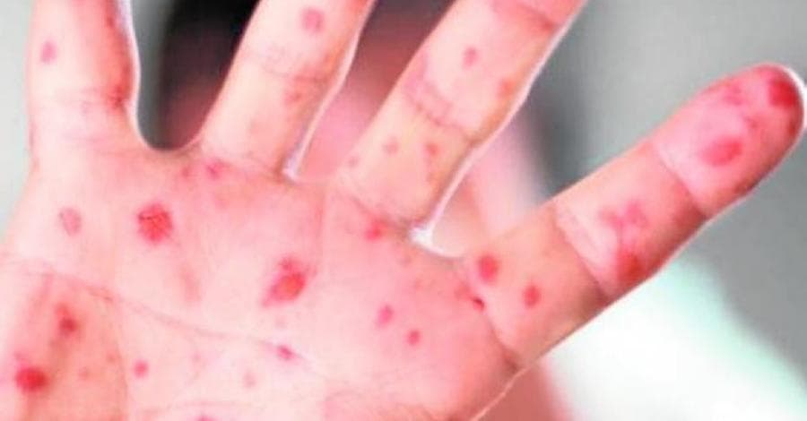 Se registra tercer caso de sarampión en Quintana Roo