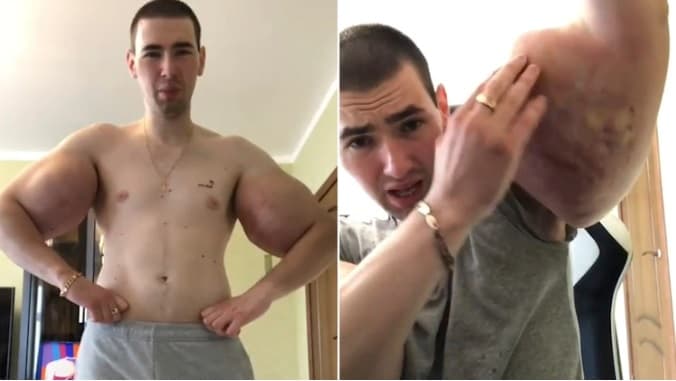 "Popeye" ruso se quita tres litros de aceite de cada brazo para no morir