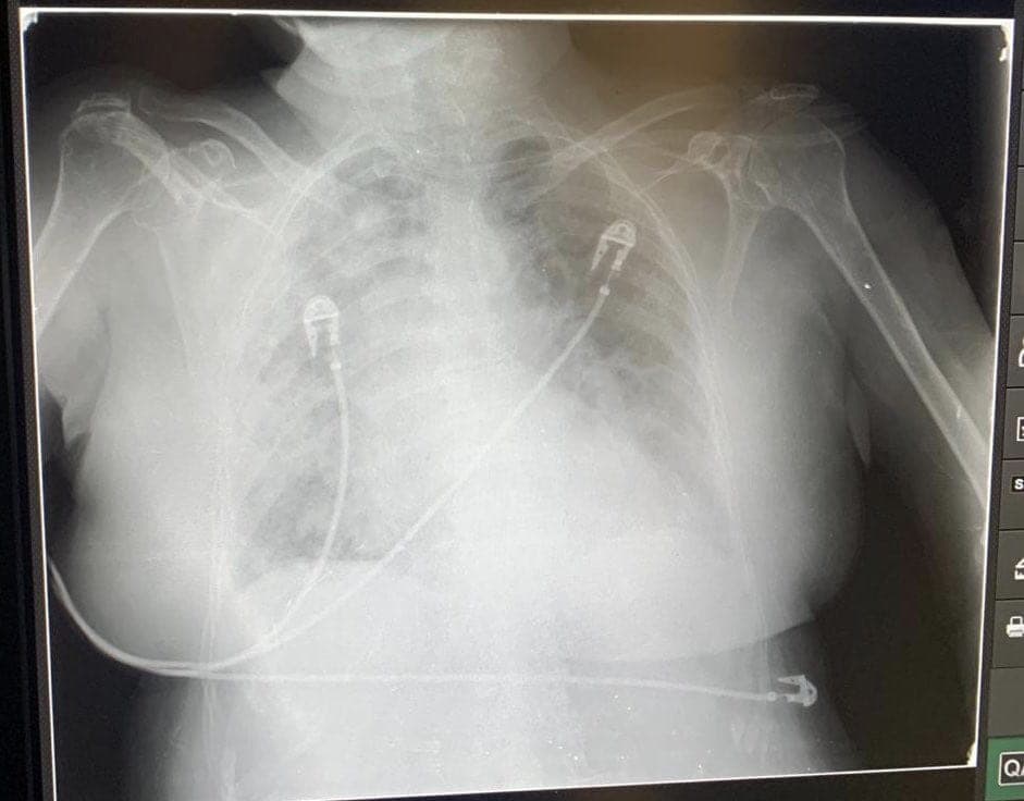 Por celebrar 10 de mayo se contagiaron de Covid-19