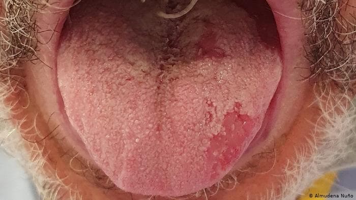 Lengua COVID: Una extraña afección como muchos otros síntomas del coronavirus