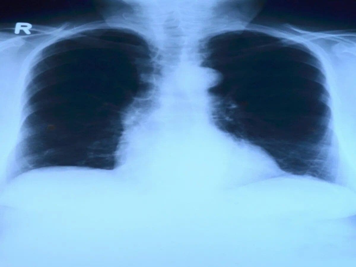 Alertan sobre aumento de muertes por tuberculosis por primera vez en años