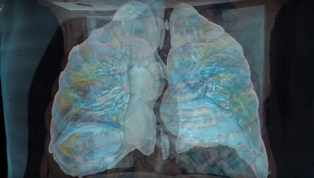 Realizan con éxito primer trasplante de pulmón a partir de donantes vivos