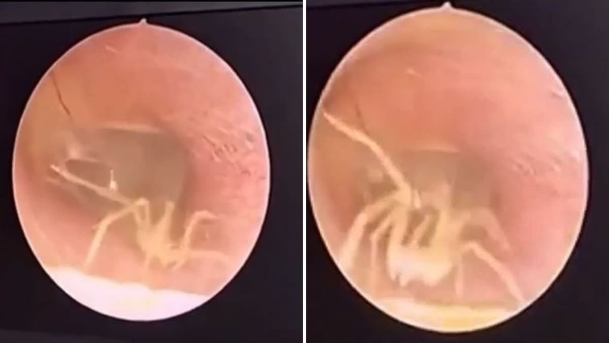 Extraen araña viva del oído de una mujer, tenía rato con un 'fuerte dolor'