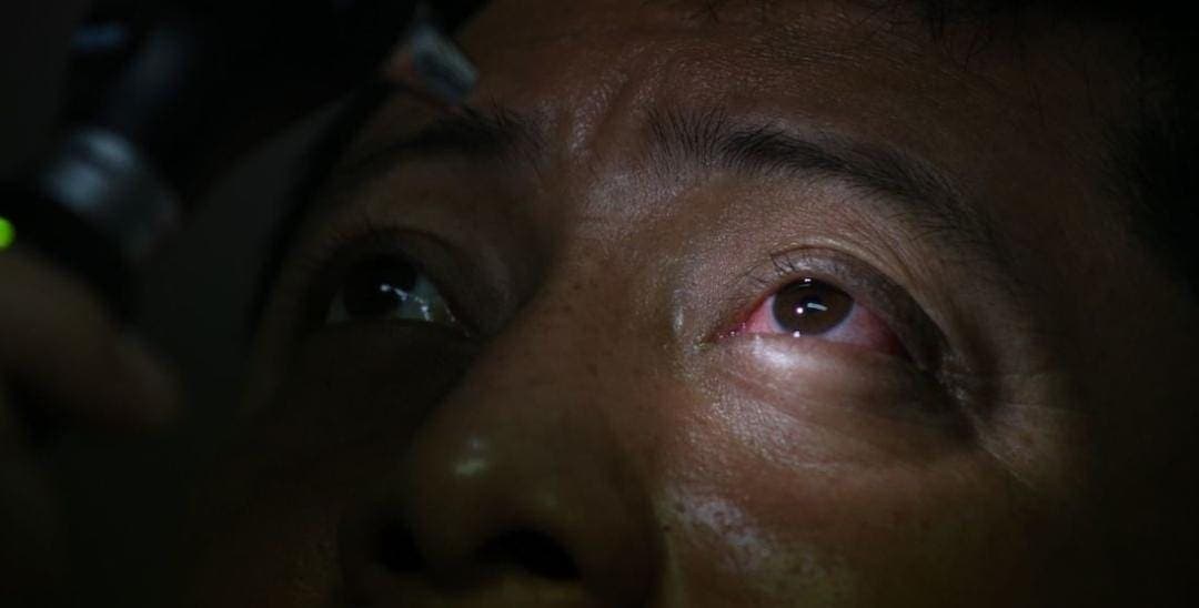 Conjuntivitis podría ser síntoma de Ómicron, advierte doctora