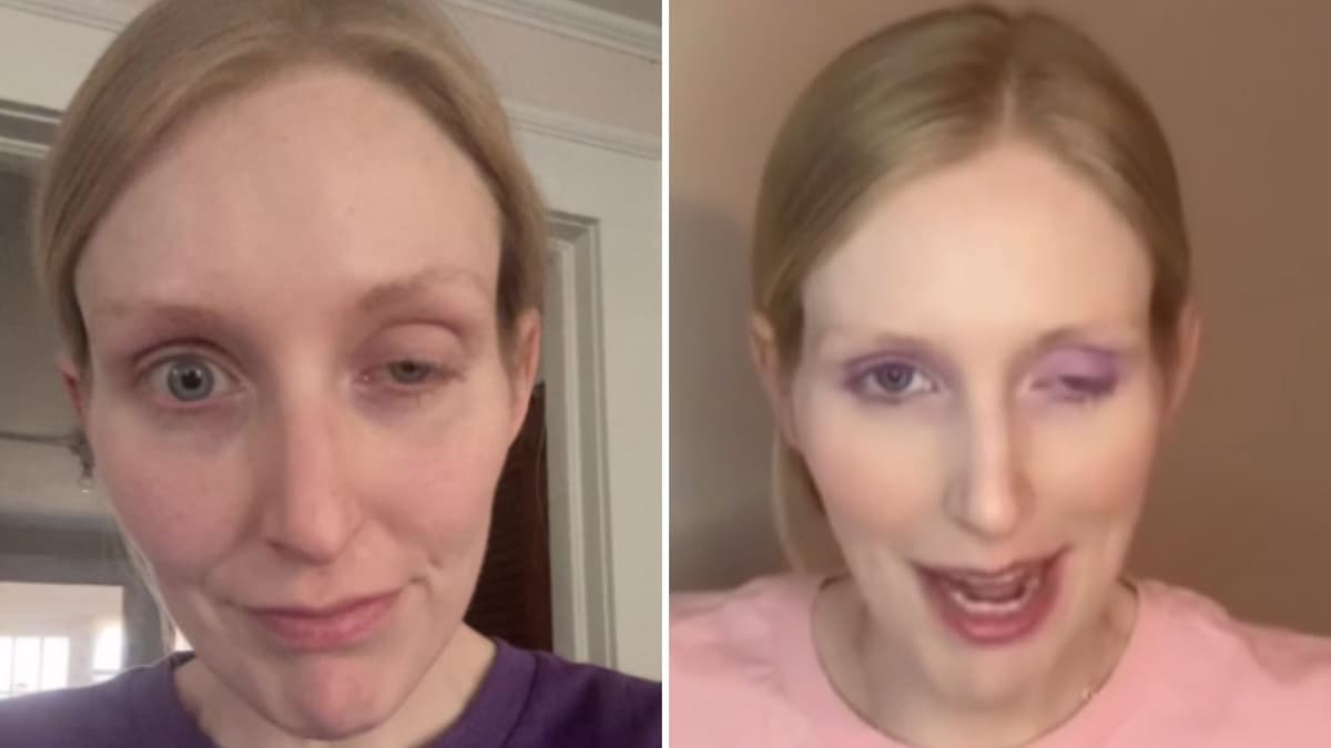 VIDEO: Tiktoker sufría de migrañas, se inyectó un ojo, casi queda ciega