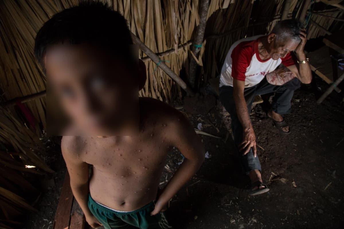 Alertan por casos de varicela en Yucatán