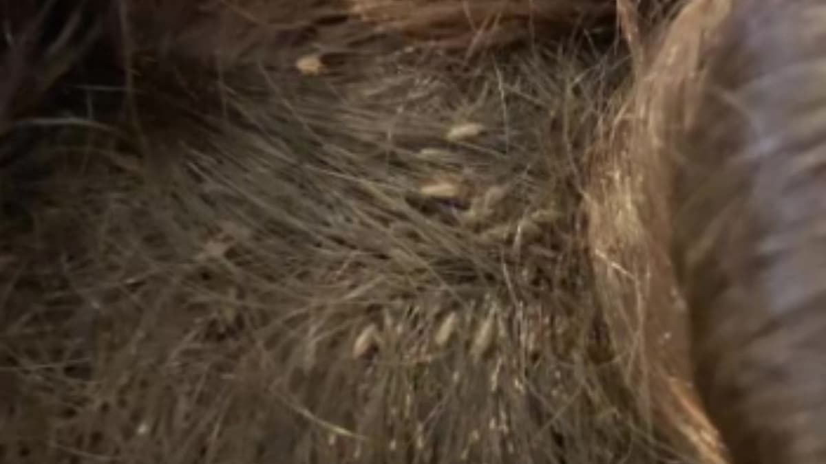 VIDEO: Revelan impactante caso de pediculosis en una niña, tardaron 9 horas en curarla