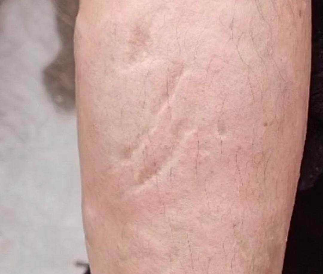 Alertan por ataque con ácido a una mujer en las calles de Puebla