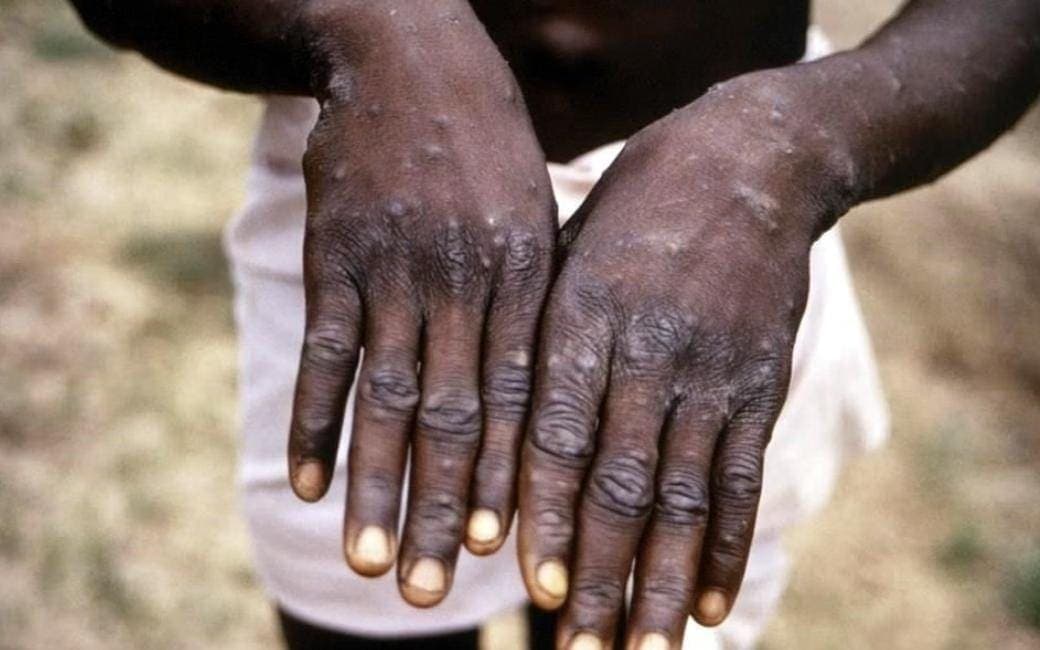 Caso de viruela del mono en Jalisco; un turista que no se cuidó y anduvo de fiesta