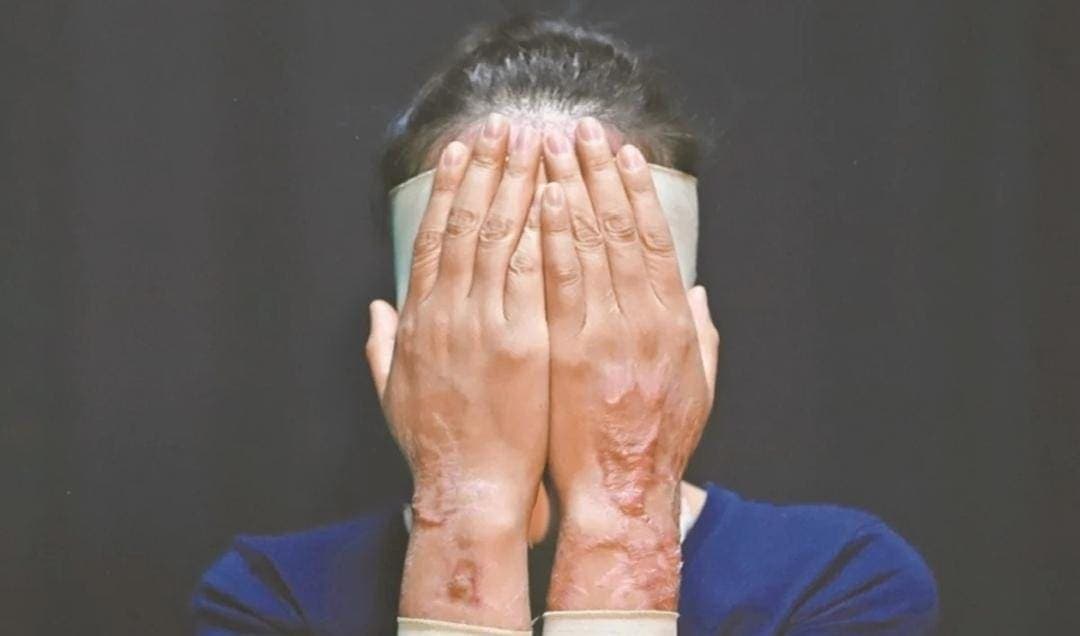 Alertan por el aumento de los ataques con ácido a mujeres en México