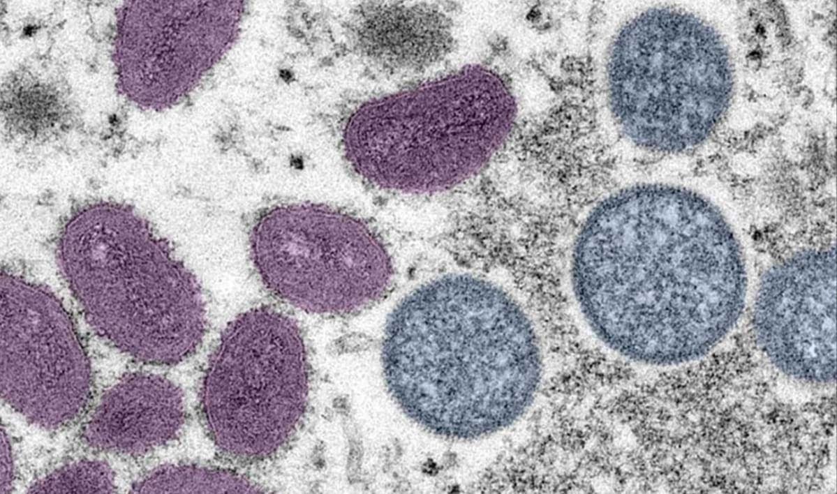 Confirman el primer caso de Covid-19, viruela del mono y VIH al mismo tiempo