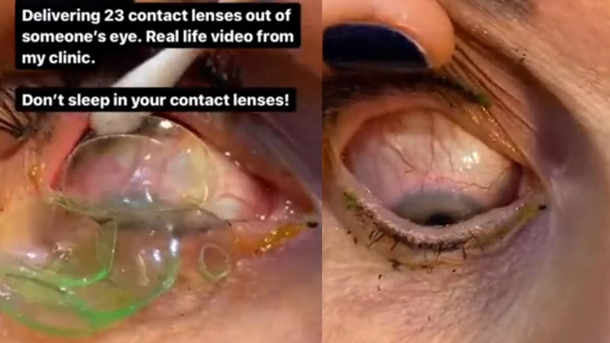 VIDEO: Extraen 23 lentes de contactos del ojo de una mujer