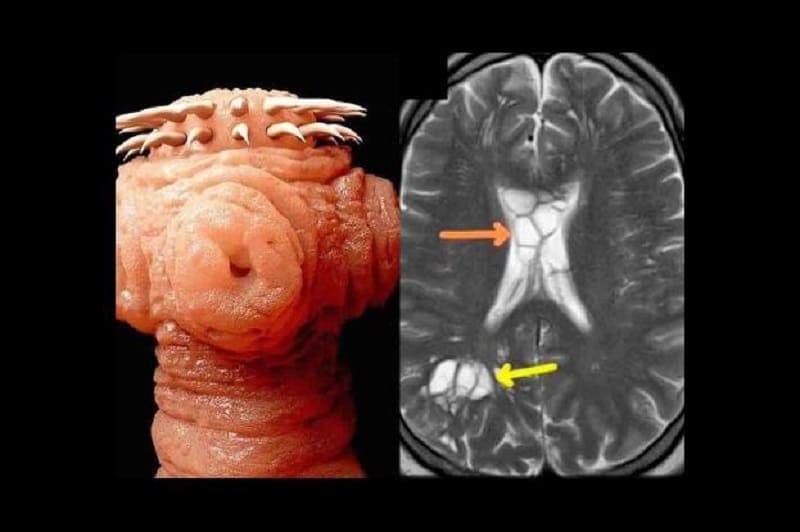 Hombre descubre que sus migrañas eran ocasionadas por un gusano vivo en su cerebro