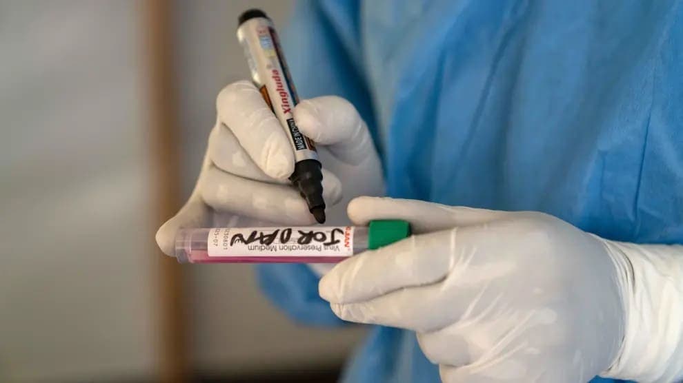 Viruela de mono en México está por alcanzar los 100 contagiados confirmados