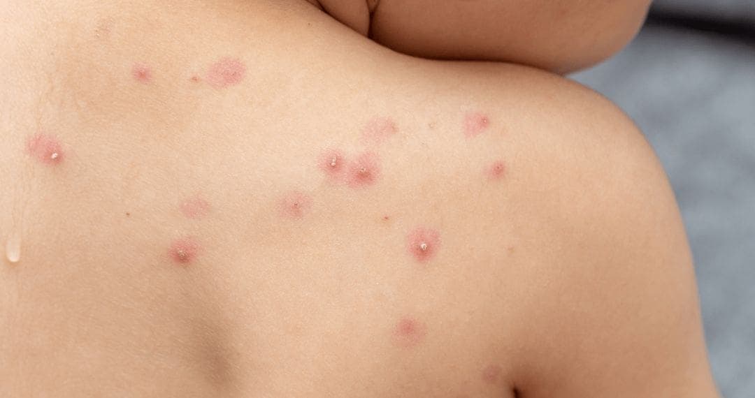 Confirman primera muerte por viruela símica en Jalisco; suman siete fallecimientos en el país