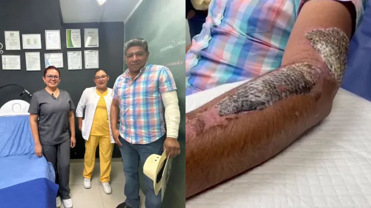 Gracias a la piel de tilapia, enfermeras ayudan de forma gratuita a quemados por explosión de pipa en Iztapalapa