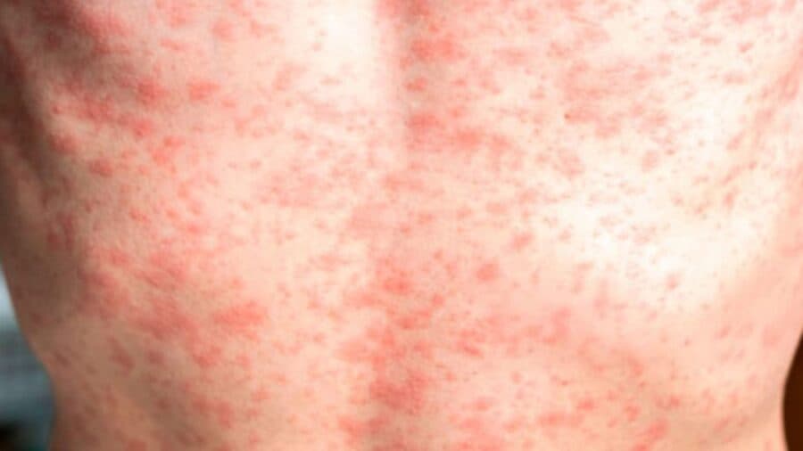 Organización Panamericana de la Salud emite alerta epidemiológica por brote de sarampión