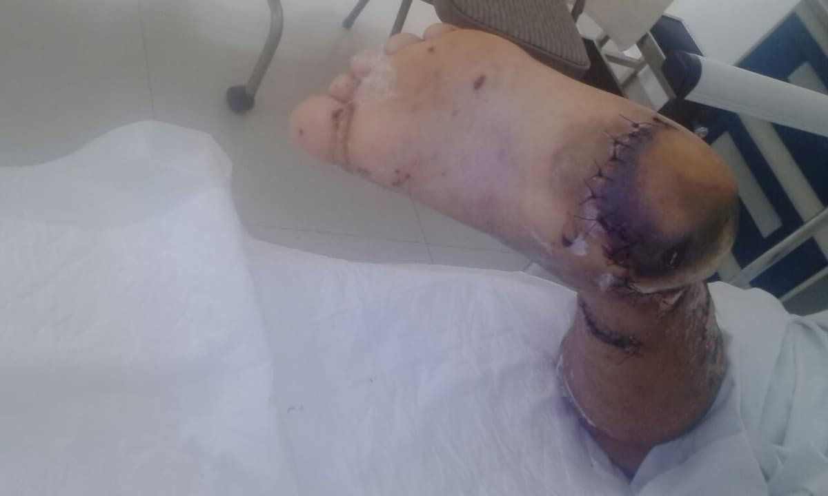 Mujer atropellada y madre de 5 hijos pide ayuda