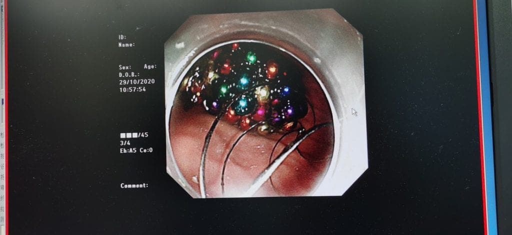 Niño dice comerse sólo 1 bolita magnética mientras veía TV pero ¡le extraen más de 100!