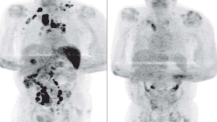 Hombre se cura de un linfoma de Hodking luego de contagiarse de Covid-19