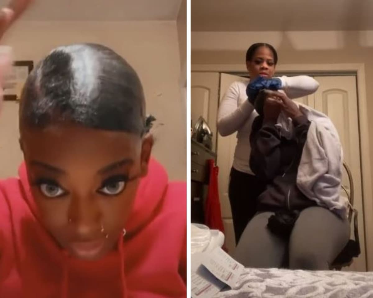 Mujer usa pegamento en vez de laca para su cabello, la hospitalizan por tener un mes sin poder quitarlo