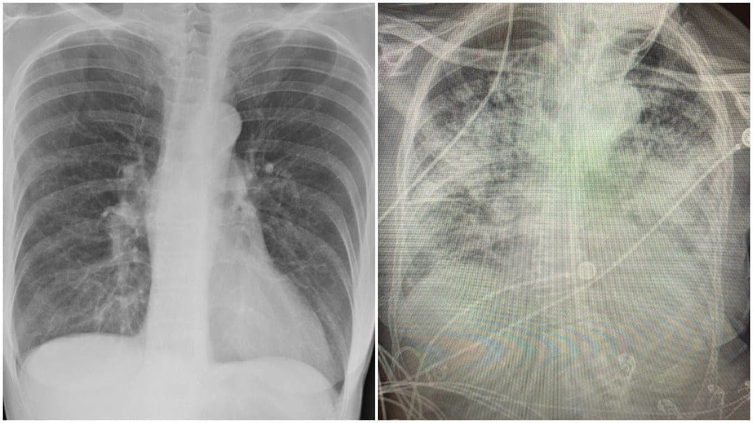 Pulmones de pacientes con Covid-19 quedan más dañados que los de fumadores