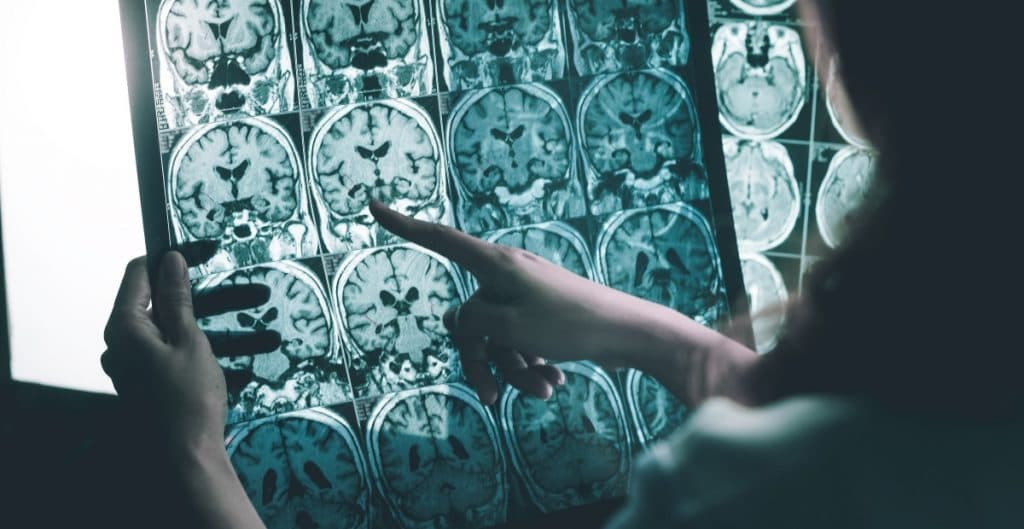 Investigan posible vínculo entre la Covid-19 y el Alzheimer