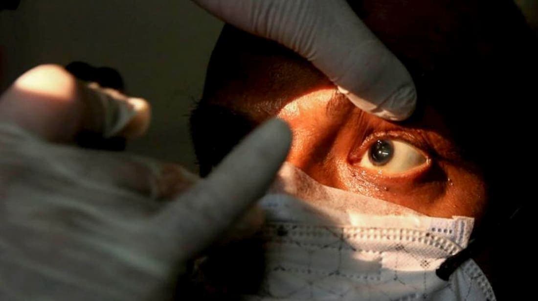 Confirman 4 casos de hongo negro relacionados con Covid-19 en Sinaloa