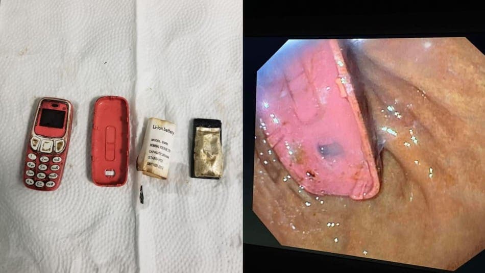 Hombre se traga un Nokia 3310 y lo operan de emergencia, le dolía el estómago