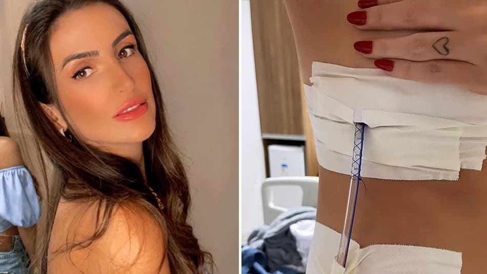 ¡Querían aliviarle el dolor de cuello! Perforan pulmón de joven durante sesión de acupuntura