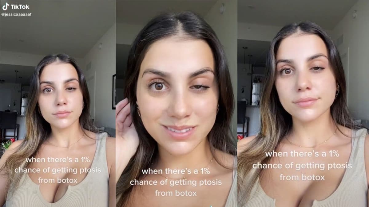 Joven se hace tratamiento de bótox pero termina con el párpado caído