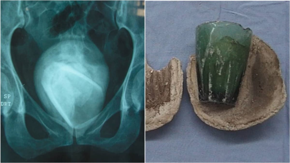 Va al hospital por una infección y descubre que tiene un vaso en la vejiga