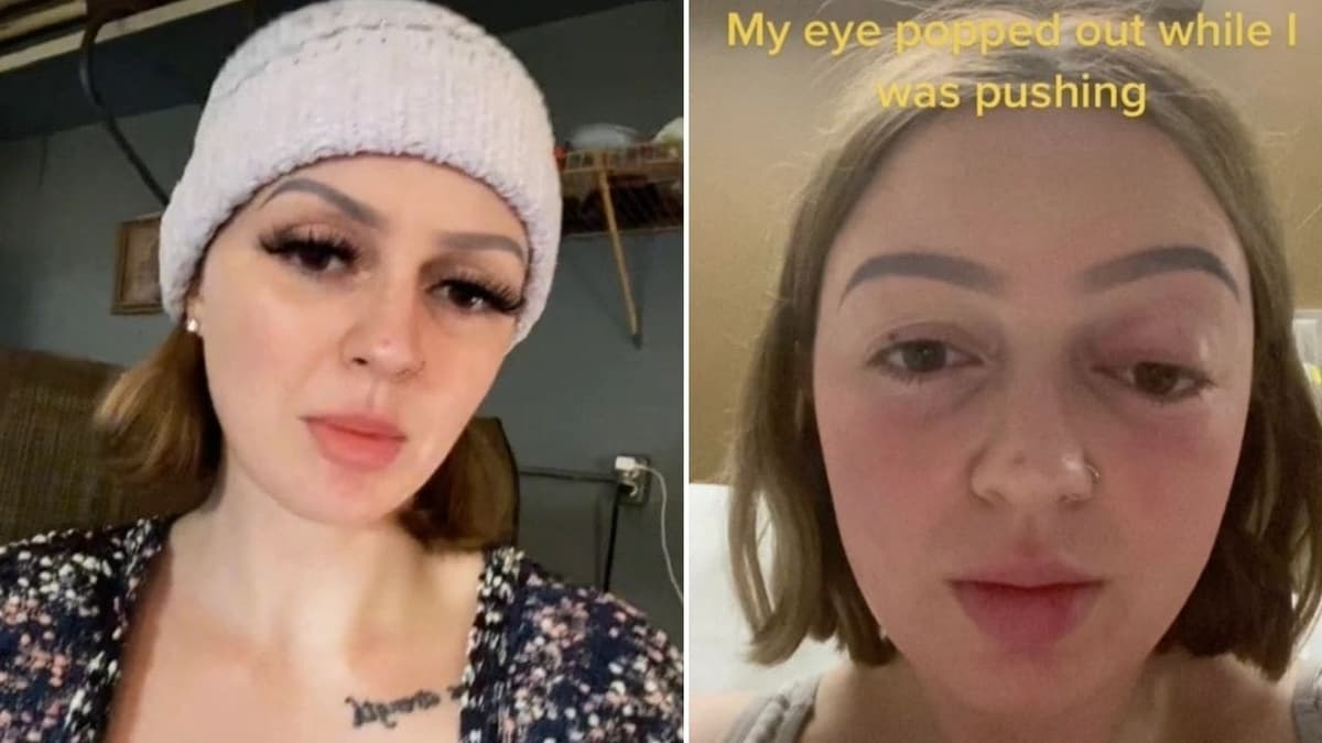 Mujer pujó tan fuerte mientras daba a luz que se le salió un ojo