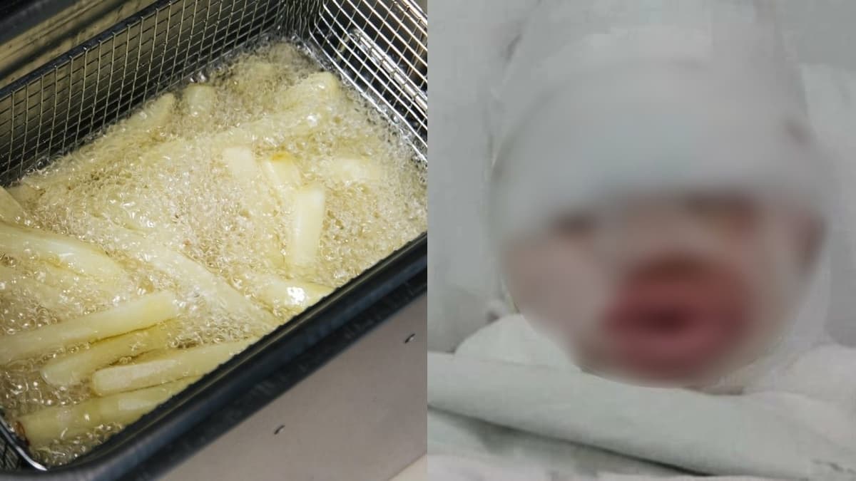 Empleada quema a bebé con aceite hirviendo y deciden meterla a una hielera