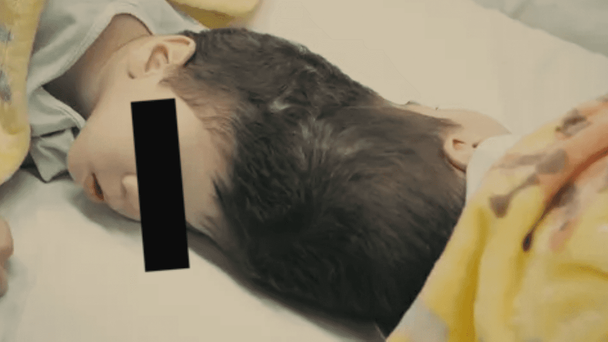 Logran con éxito separación de siameses unidos por la cabeza en Brasil