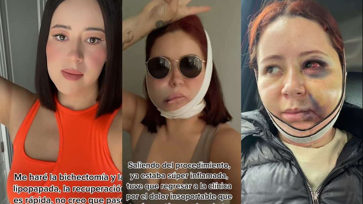 VIDEO: Mujer se hace la bichectomía y resultado sale mal