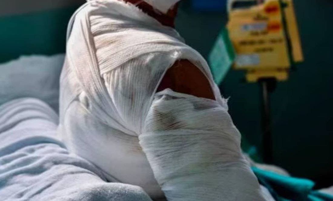 Sujeto rocía alcohol y le prende fuego a mujer en situación de calle en CDMX