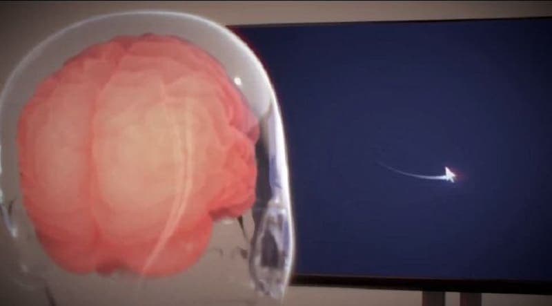 Primer paciente con chip cerebral puede controlar un ratón de computadora con el pensamiento