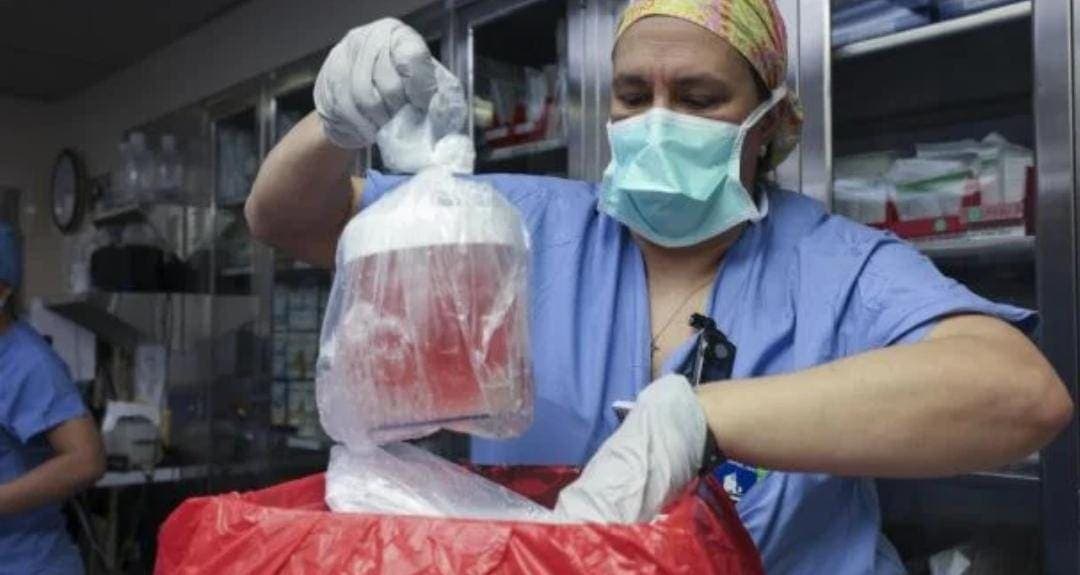 Muere la primera persona que recibió un riñón de cerdo modificado genéticamente