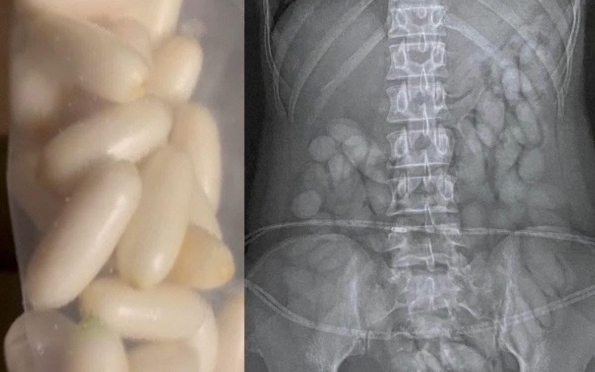 Video: Detienen a mujer con 63 'balas' de cocaína en su organismo en Sudáfrica