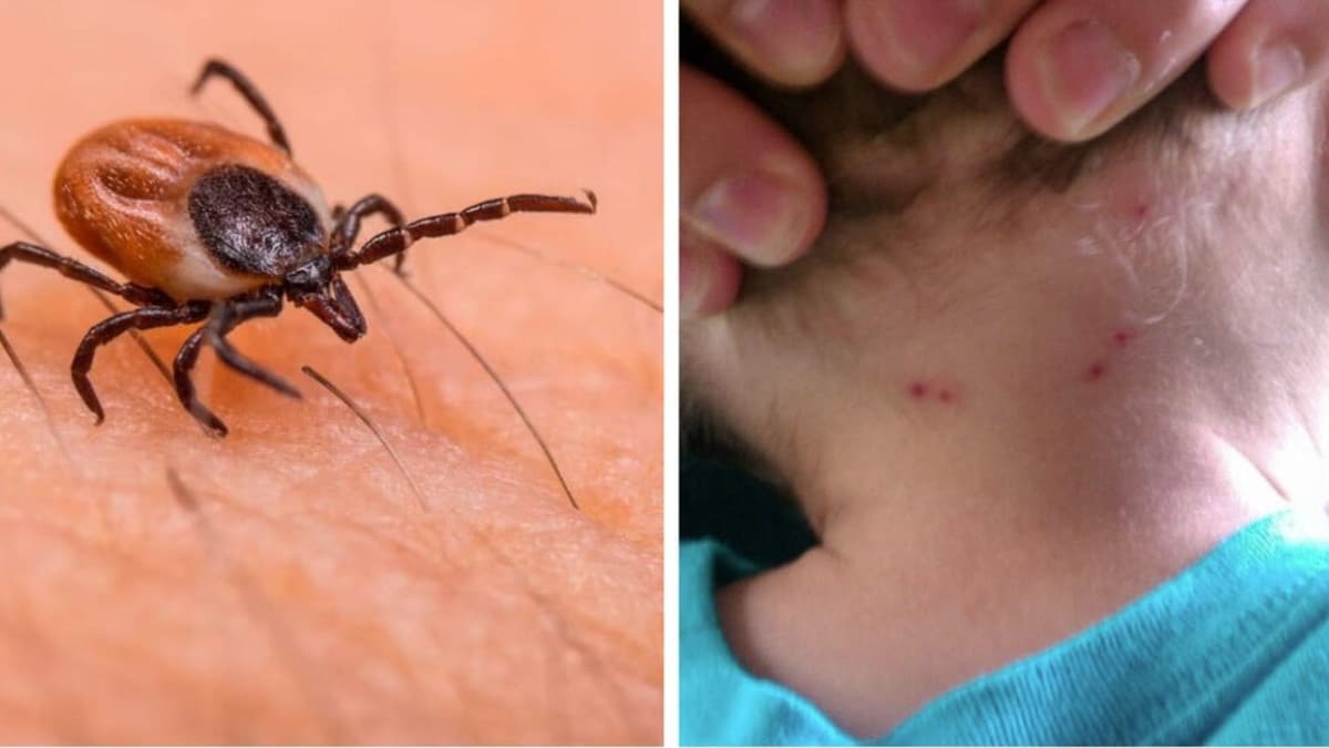 Niño de cinco años pierde la vida tras picadura de garrapata en Saltillo, Coahuila