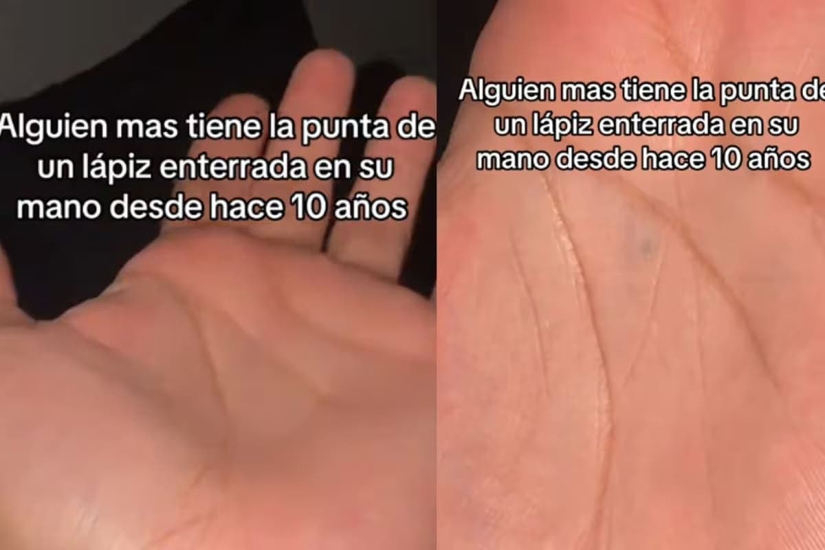 VIDEO: Hombre se hace viral por mostrar la punta de un lápiz enterrada en su mano desde que tenía 10 años