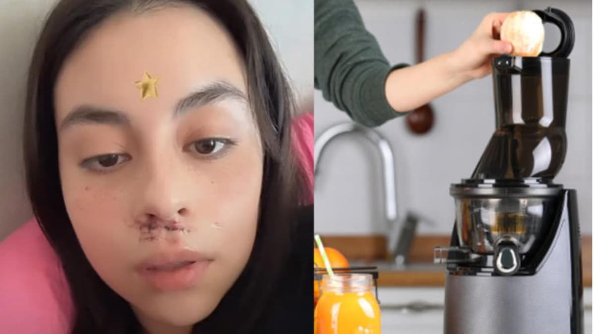 Joven sufre lesión en la cara tras fallarle el extractor de jugos que compró en Amazon