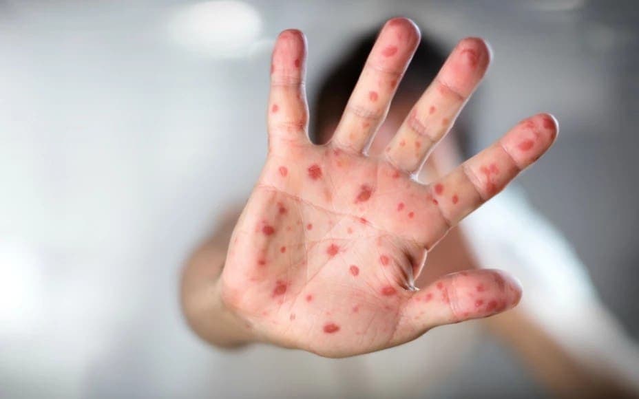 Mueren dos niños por complicaciones de sarampión en Chihuahua