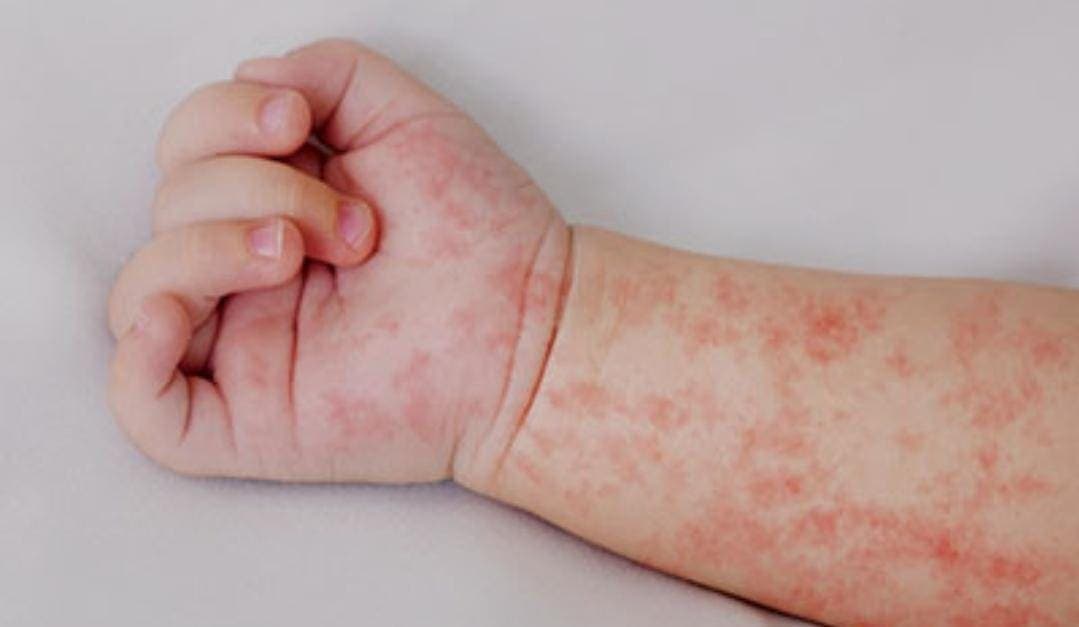 Se confirma primer caso de sarampión en Quintana Roo desde 2019, es una menor de Bacalar