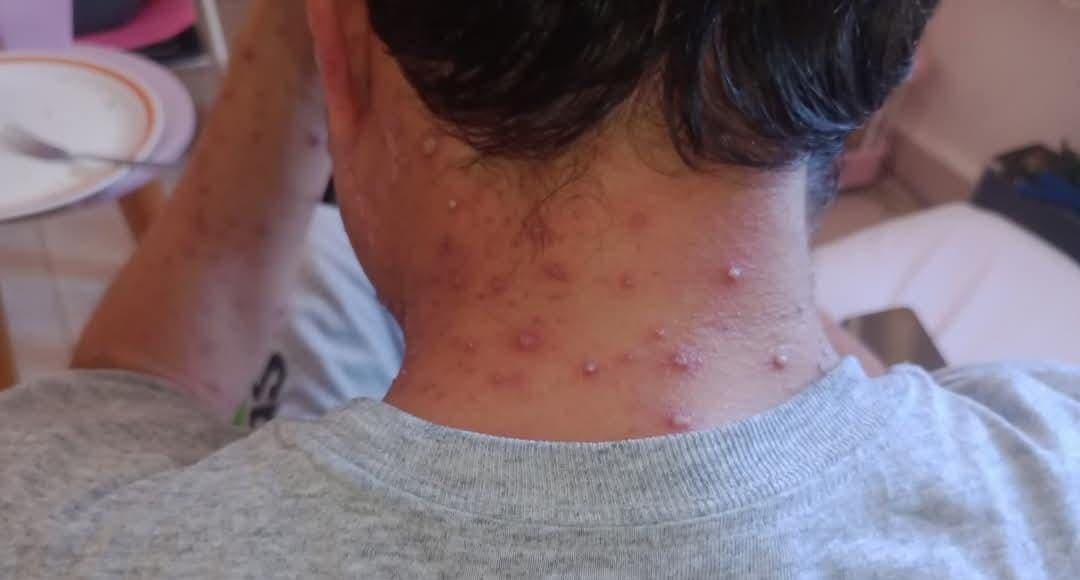 Descartan autoridades de Playa del Carmen supuesto caso de viruela símica que circula en redes sociales