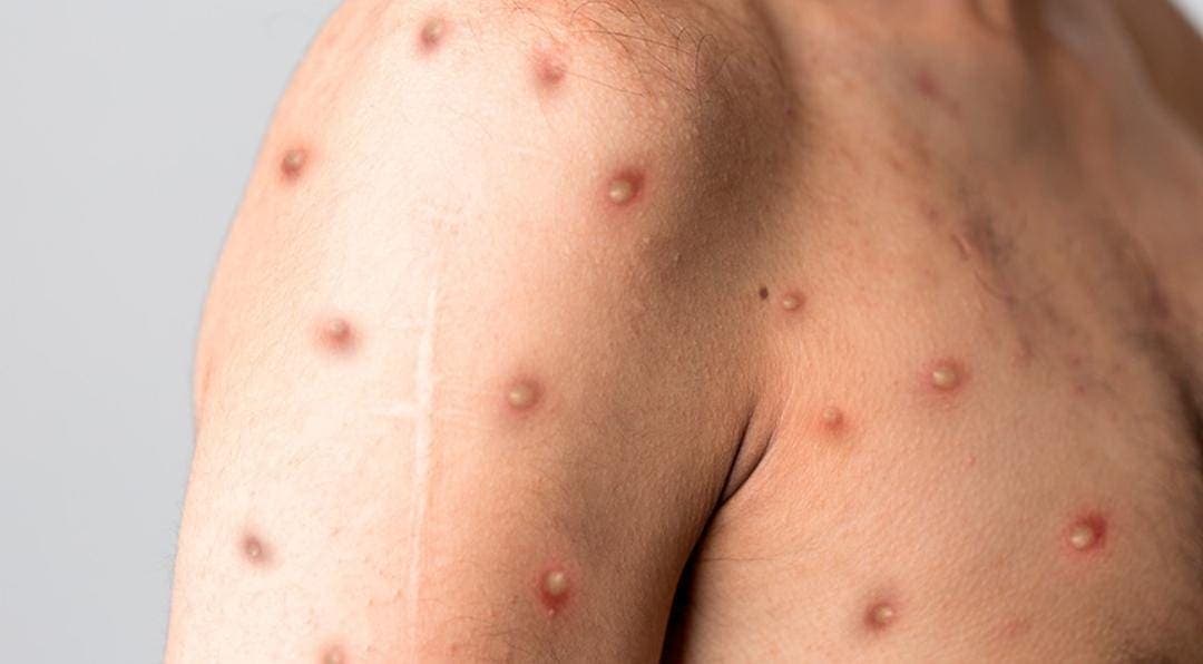 Fallece paciente con viruela símica en Quintana Roo; era el caso enviado de Playa del Carmen a Cancún