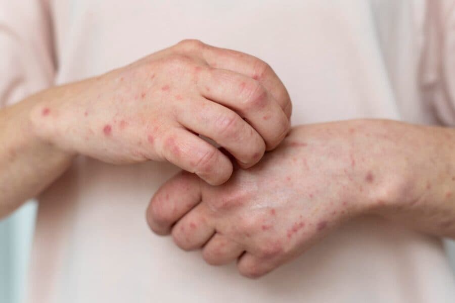 Confirman primera muerte por sarampión en México en 2026